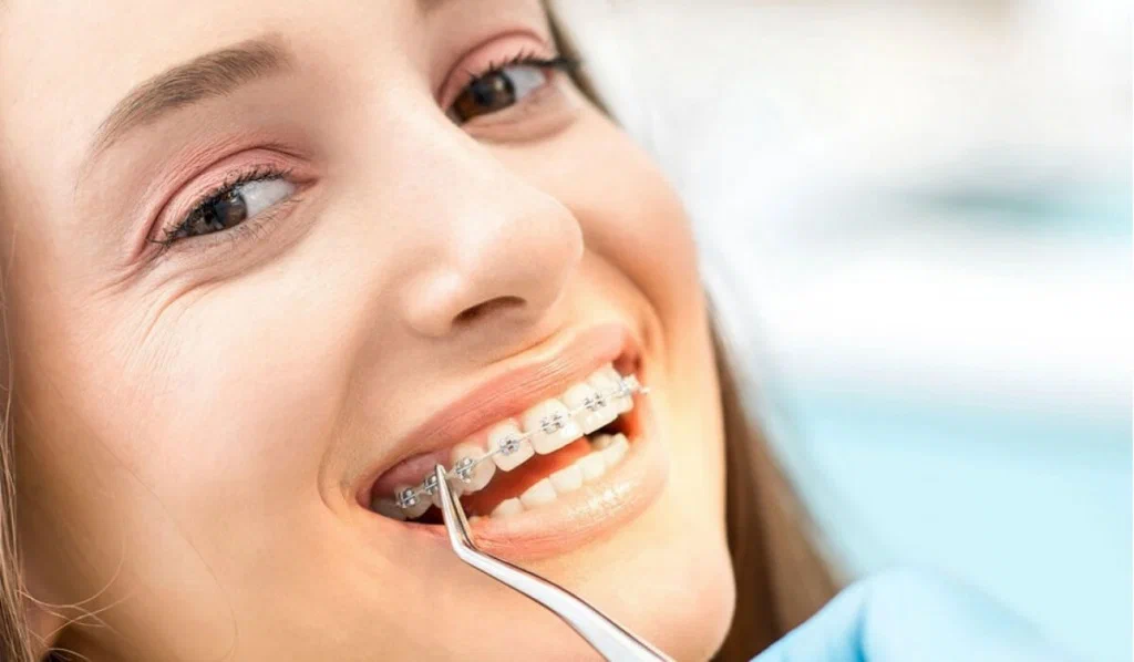 cheapest braces in singapore for students