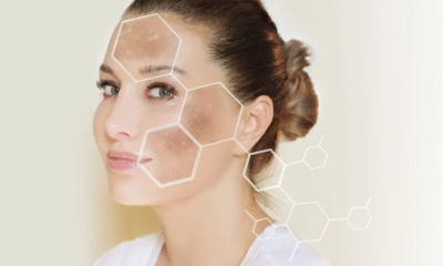 Restore Skin Confidence Through Structured Melasma Treatment